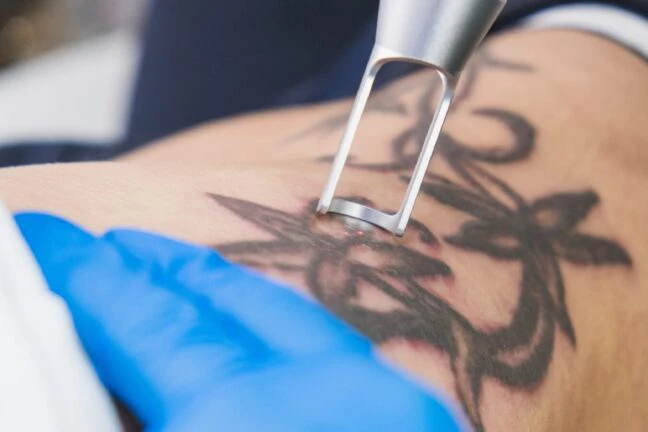 Tattoo removal | Laser treatments Monday Aesthetics | Burlington, WA