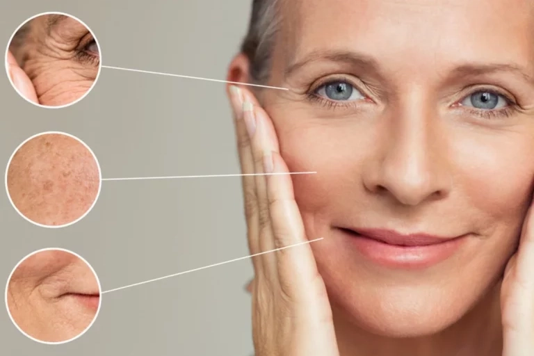 Sculptra treatments from Monday Aesthetics | Burlington, WA