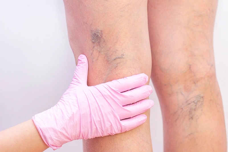Spider vein treatments from Monday Aesthetics | Burlington, WA